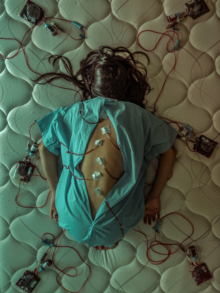 A woman curled into a ball lies face down surrounded by tubes and bags of blood attached to her exposed back.